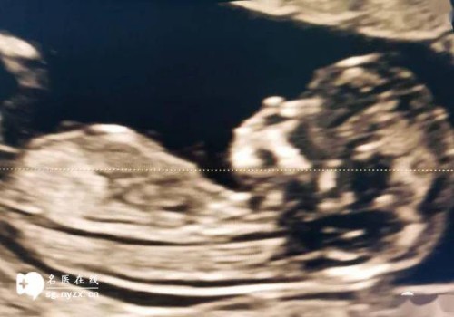 生孩子后更容易患恶性子宫肌瘤吗？