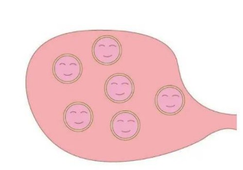 怎样解决子宫肌瘤带来的困扰？