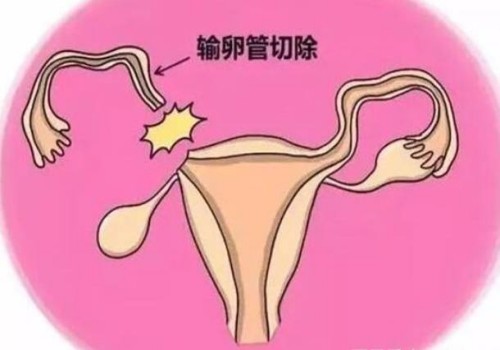 广州助孕生子：试管长短方案不能随便选，要根据自身情况而定